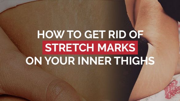 How To Get Rid Of Stretch Mark On Your Inner Thighs Featured Image