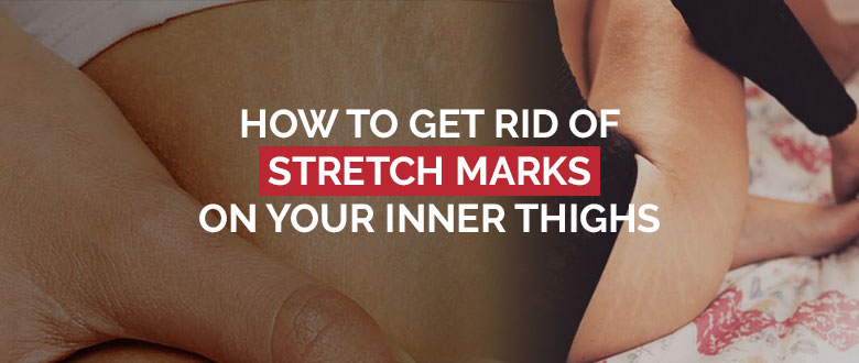 How To Get Rid Of Stretch Mark On Your Inner Thighs Featured Image